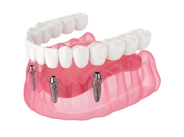 Rendering of a fixed full arch of teeth supported by implants