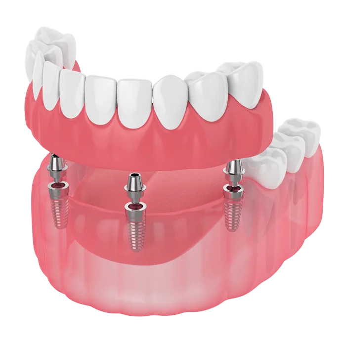 Rendering of a denture secured onto dental implants