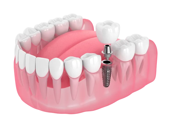 Rendering of a single dental implant with a crown